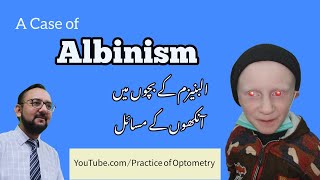 Albino  Albinism  Oculocutaneous Albinism  Why Are Some Children Albino  Practice Of Optometry [upl. by Lenssen]