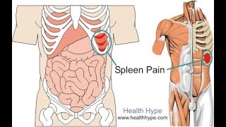 spleen injury  splenic injury  spleen injury causes  signssymptoms [upl. by Nellir450]