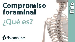 Compromiso foraminal o del neuroforamen  ¿Qué es [upl. by Okihsoy389]