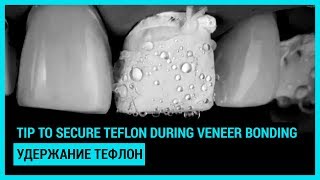 Tip to secure teflon during veneer bonding Удержание тефлон во время адгезивных манипуляций [upl. by Nimaj]