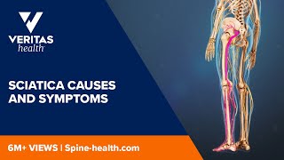 Sciatica Causes and Symptoms [upl. by Cimbura]