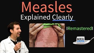 Measles Symptoms Diagnosis Vaccine Treatment Explained [upl. by Cliffes]