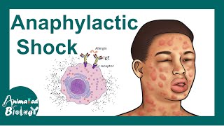 Anaphylactic shock  Anaphylactic Reaction Symptoms and Treatment [upl. by Acino]