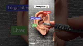 Ear Acupuncture for Constipation acupunctureworks [upl. by Nnaes]