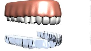 Teeth Whitening [upl. by Rosenthal]