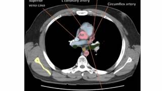 Anatomy of a Transverse CT of the Thorax [upl. by Outhe]