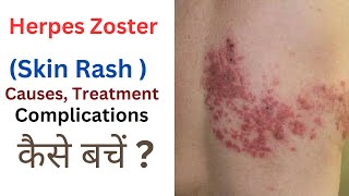 Herpes Zoster  Skin Rash Cause treatment कैसे बचें  shingles herpeszoster skinrash [upl. by Rilda]