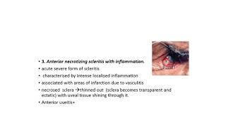 ophthalmology ANATOMY AND DISEASES OF SCLERA 1 [upl. by Enelrak]