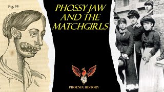 Phossy Jaw And The Matchgirls [upl. by Sana]