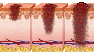 Comment définiton un ulcère de jambe [upl. by Yhtorod]