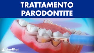 Trattamento parodontite – Curettage e sondaggio parodontale © [upl. by Kinnie17]