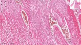 Myocardial Infarction  Histopathology [upl. by Akamahs]