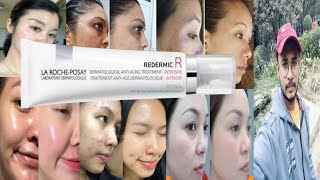 la roche posay redermic r retinol cream  honest review [upl. by Warila]