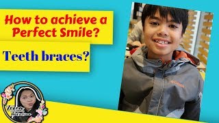 How to achieve a perfect smile l first step of Braces l Brackets [upl. by Amoritta]