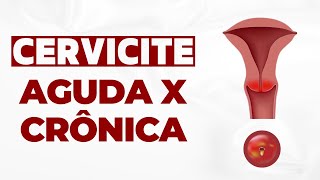 Qual a diferença de cervicite crônica e cervicite aguda [upl. by Siger278]