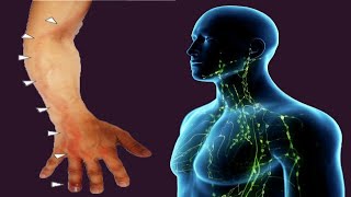 Lymphangitis Causes And Symptoms [upl. by Cita]