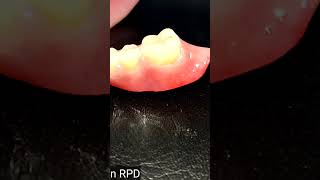 Prosthodontics insertion acetal rpd [upl. by Aihsoj]