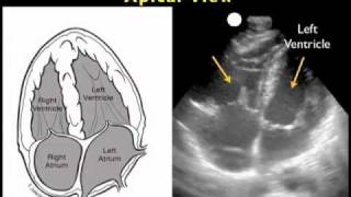 How to Cardiac Ultrasound  Apical View Case Study [upl. by Aihsein]