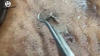 INGROWN HAIR REMOVAL VIDEO 2024 [upl. by Romy]