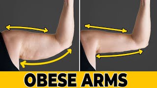 LOSE FLABBY OBESE ARMS FAT  SUPER EASY FOR BEGINNERS amp OBESE [upl. by Ahusoj]