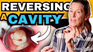 How To Reverse a Cavity at Home  Cure Tooth Decay [upl. by Ocinemod862]