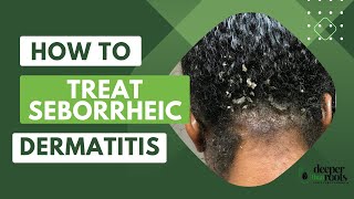 How to treat Seborrheic Dermatitis deeperthanrootsscalpcare [upl. by Asfah347]