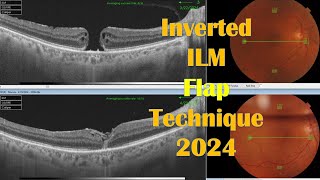 Macular Hole Inverted ILM Flap Technique 2024 [upl. by Grimonia]