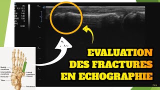 Diagnostiquer une fracture en échographie [upl. by Chor]