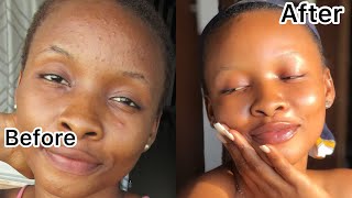 How I Truly Got Rid Of My Pimples In 2 Weeks  Clear Skin [upl. by Mechelle]