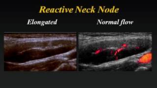 Ultrasound of Cervical Lymph Nodes [upl. by Ydroj]