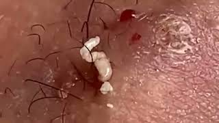 Blackheads Removal  Acne Treatment and Very Satisfying Satisfying Pimple pop blackheads [upl. by Ahkos694]