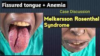 Fissured tongue Anemia  Melkersson Rosenthal Syndrome Case Discussion [upl. by Bred]