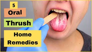 How To Treat Oral Thrush Oral Candidiasis Or Yeast Infection At Home  Best Home Remedies [upl. by Lanza]