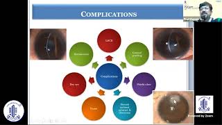 Vernal Keratoconjunctivitis  Prof Rajesh Sinha [upl. by Valry]