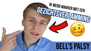 Ik kreeg de diagnose van Bells Palsy halfzijdige gezichtsverlamming 🥴 [upl. by Griffiths854]