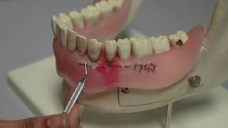 Periodontal Examination Series10Gingival Recession Miller Classification Gingival Recession1985 [upl. by Ainaznat]