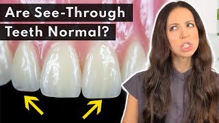 Why Are My Teeth TRANSLUCENT amp How to FIX It 🦷 [upl. by Attenyw766]