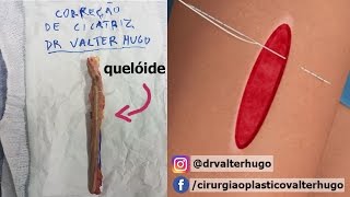 CIRURGIA CORREÇÃO DE CICATRIZ QUELÓIDE Antes Depois  Dr Valter [upl. by Hulda2]