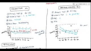 Conductive and Sensorineural Hearing Loss Deafness for USMLE [upl. by Anileda297]