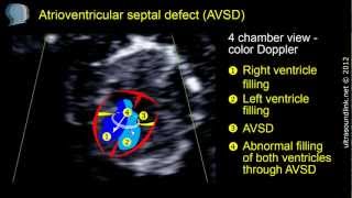 Atrioventricular septal defect AVSD at 11 weeks gestation [upl. by Eloisa946]