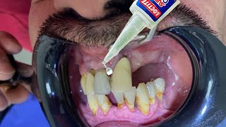 Le PEGARON los DIENTES con SUPER GLUE 😱😱😱 [upl. by Geneva586]