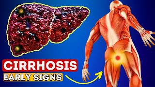 12 Early Signs of Liver CIRRHOSIS  LIVER is DYING [upl. by Rosene]