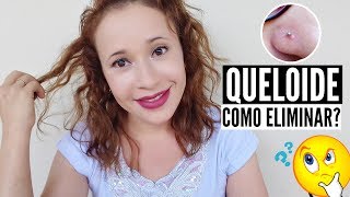 COMO ELIMINAR QUELOIDE DO PIERCING  DUAS DICAS  POR LEYA ARAGÃO [upl. by Giaimo484]