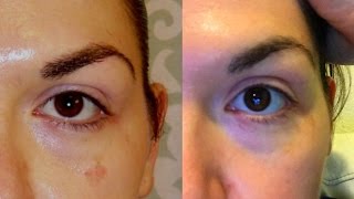 It Works Before and After Hydroquinone [upl. by Kcirdez801]