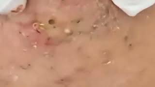 Punti Neri Acne Blackheads Removal pt1 [upl. by Gnaw259]