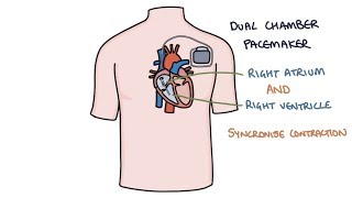 Understanding Pacemakers [upl. by Nnaeitak]