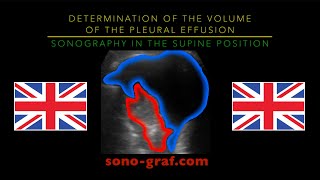 Sonography  Determination Of The Volume Of The Pleural Effusion In The Supine Position [upl. by Boak]