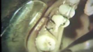 Gingival and Bone Grafting for New Attachment [upl. by Nej]