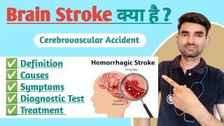 Cerebrovascular Accident in Hindi  Causes Symptoms And Treatment of Brain Stroke in Hindi [upl. by Eremahs377]