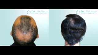 3000 Grafts FUE Hair Transplant Dr Michalis  Crown [upl. by Ahtebat562]